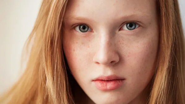 黄褐斑中医治疗