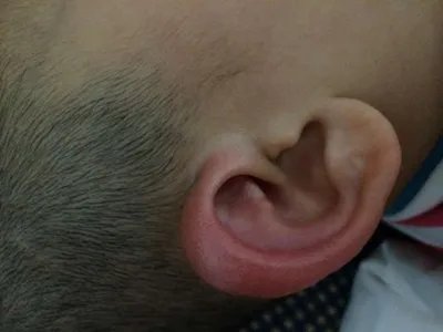 蜱咬伤红肿图片