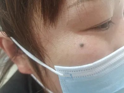 皮内痣黑痣图片
