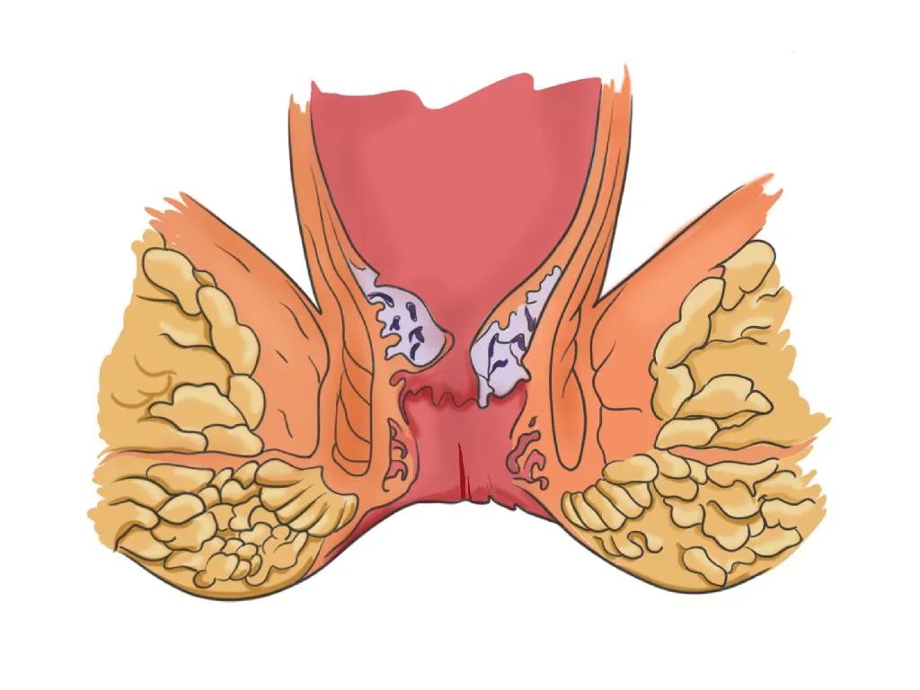 肛裂最真实图片