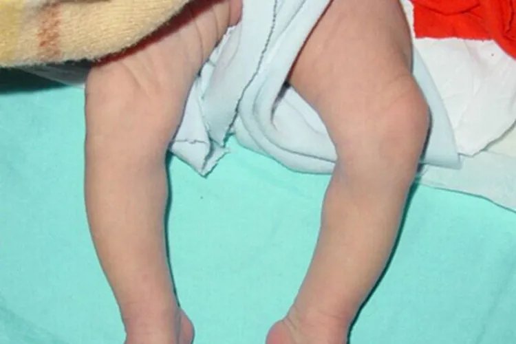 佝偻病儿童图片