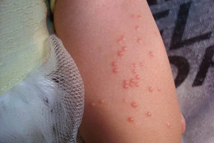 水瘊子图片皮肤病怎么治疗方法