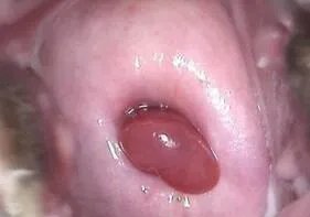 宫颈息肉图片大全