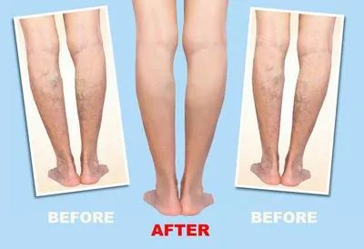 变应性血管炎怎么检查