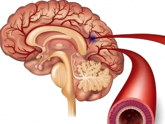脑膜炎双球菌的症状