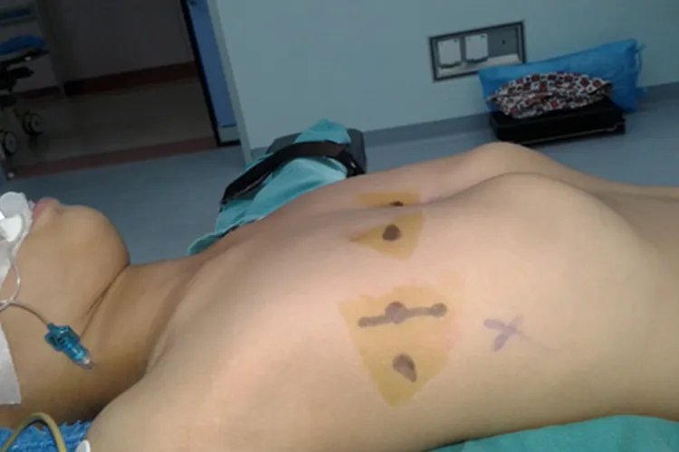 佝偻病儿童图片