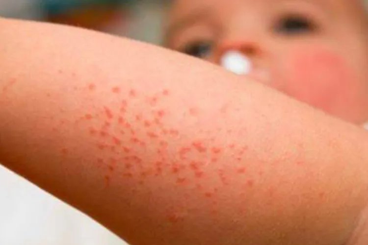 麻疹早期症状图片