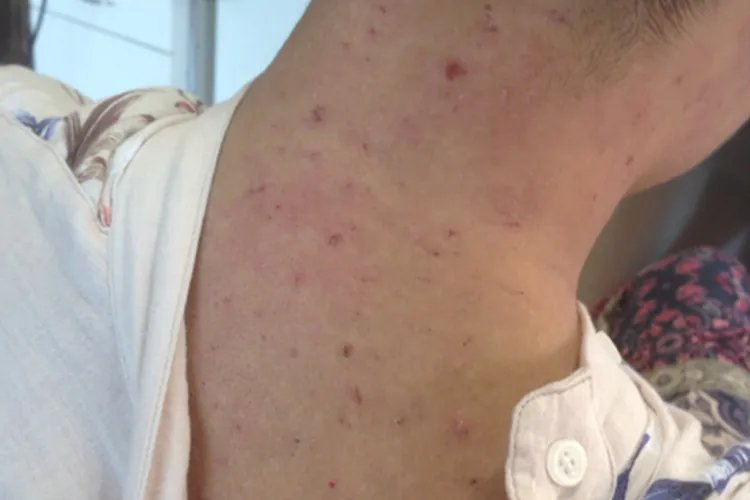 男人后背长痘痘图片