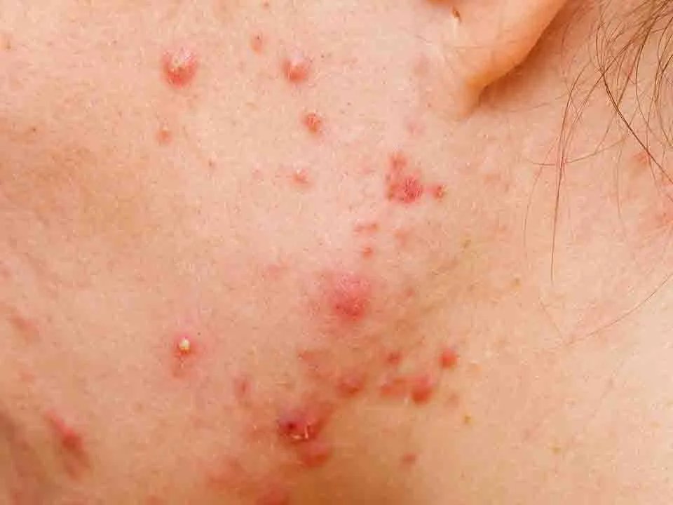 荨麻疹最佳治疗方法有哪些