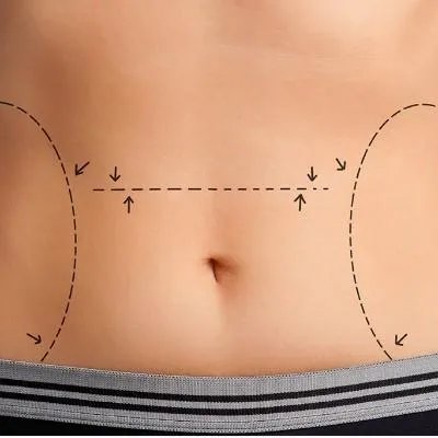 剖腹产如何减肥