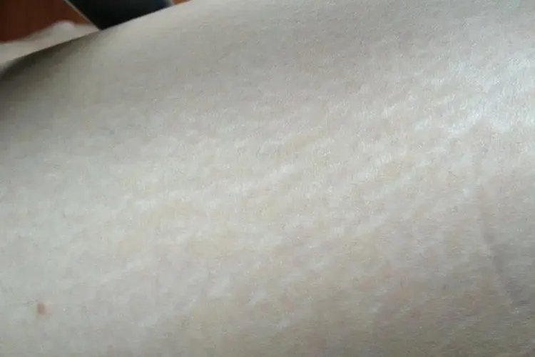 腿部肥胖纹图片