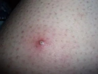 毛囊炎疙瘩图片