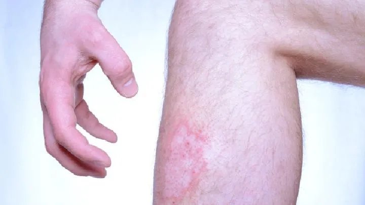 牛皮癣的症状
