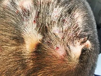 毛囊炎疙瘩图片