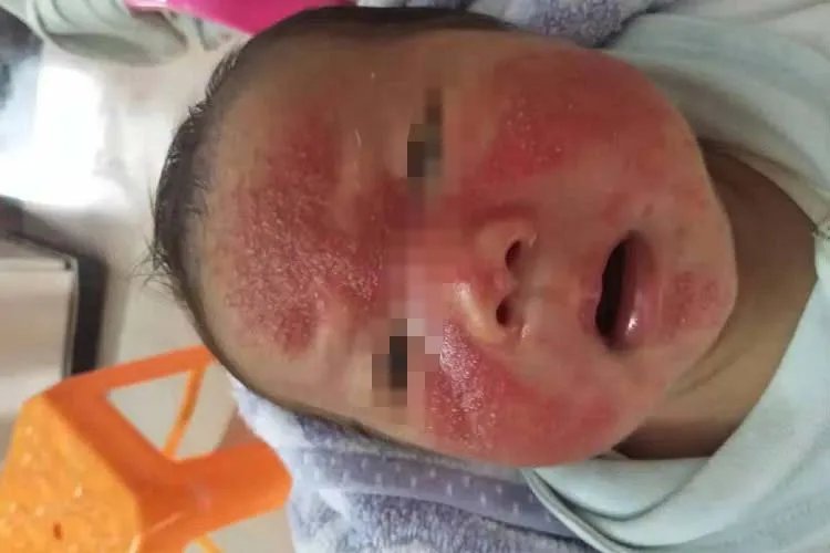 皮炎的10种症状图片