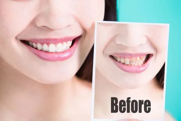 冷光美白牙齿怎么收费