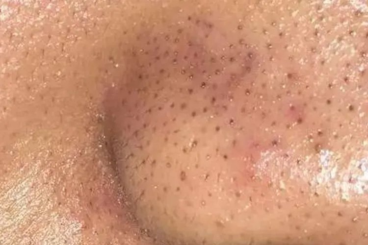 黑头一般长在哪些部位