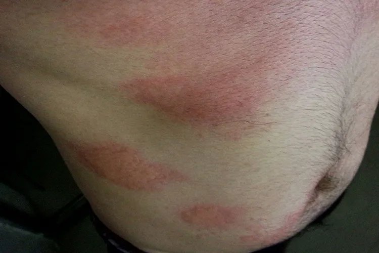 风疹症状图片及病因