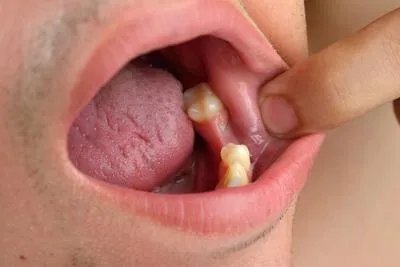 舌头边缘有齿痕是什么原因造成的