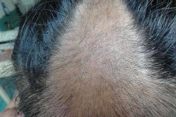 头癣的症状图片