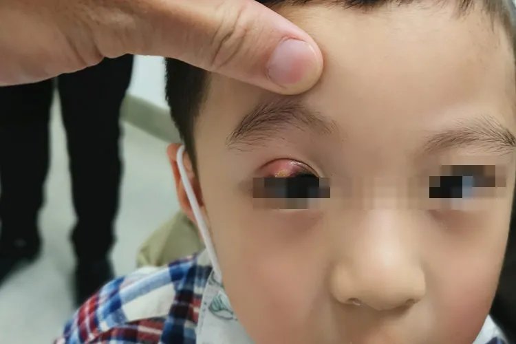 小儿麦粒肿早期图片