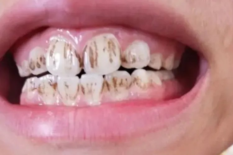 牙垢牙结石图片