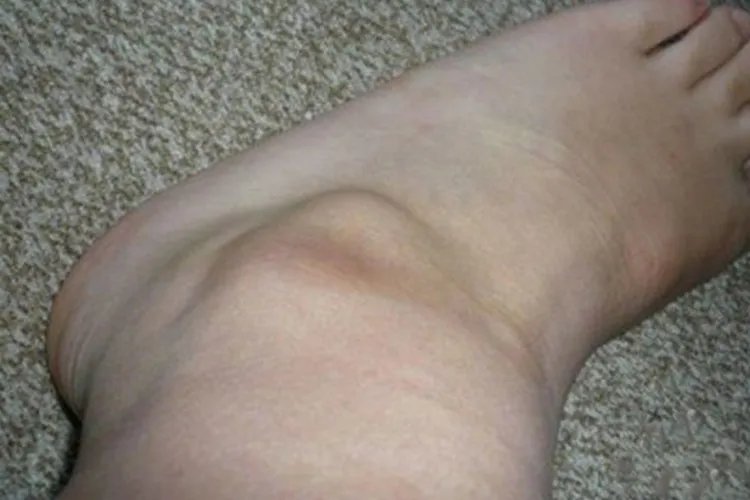 儿童腱鞘囊肿图片