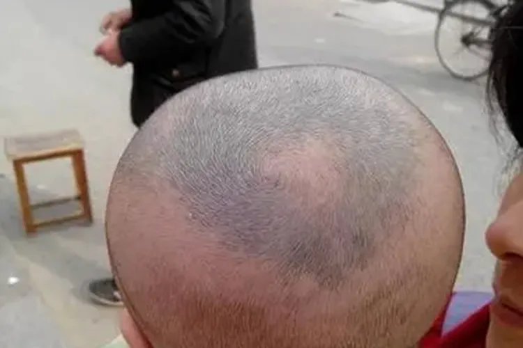 婴儿头顶有青色胎记图片