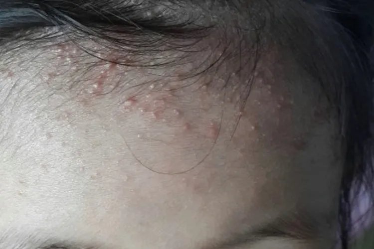 宝宝身上起痱子图片