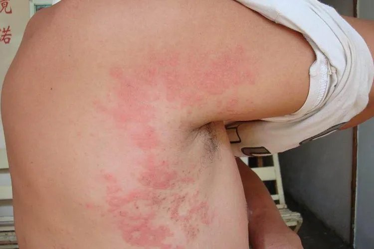 人被螨虫咬的症状图片