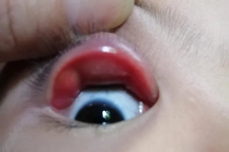 小儿麦粒肿早期图片