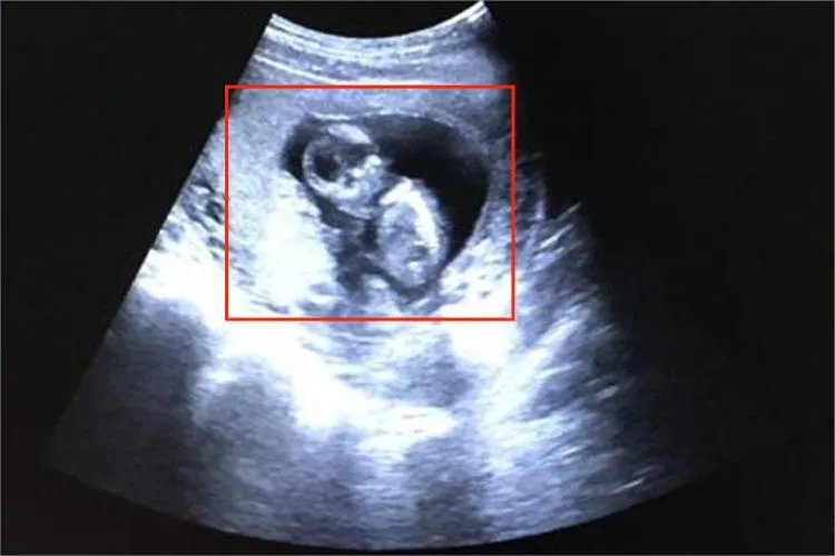 怀孕76天真实胎儿图