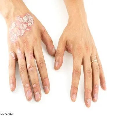 副银屑病能吃什么