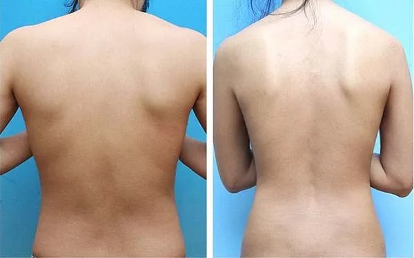 抽脂美容术后注意事项