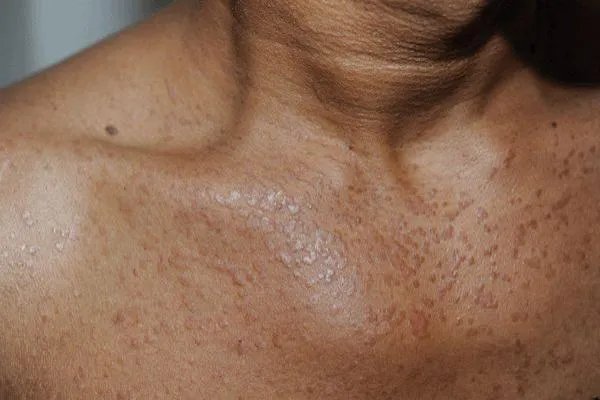 胸口长小肉粒图片