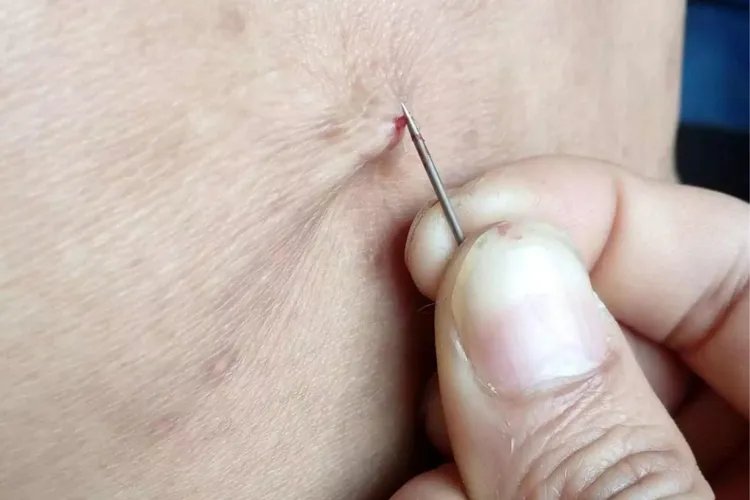 羊毛痧的症状图片