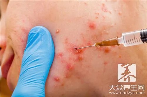 粉刺瘤扎破挤出能好吗