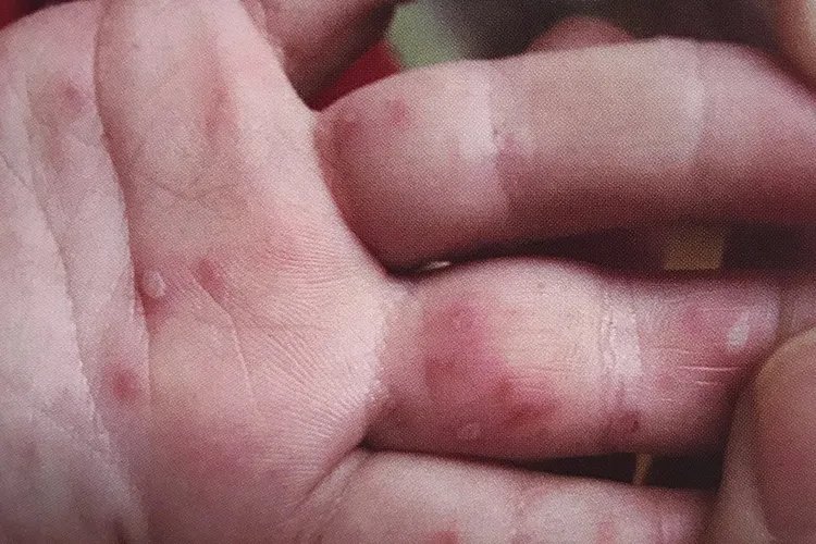 感染手足口病毒图片