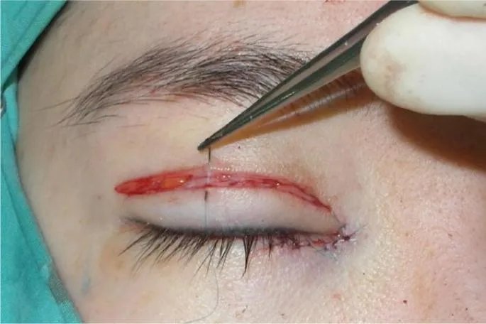 割双眼皮和埋线的图片