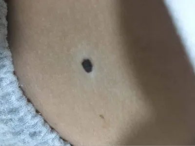 皮内痣黑痣图片