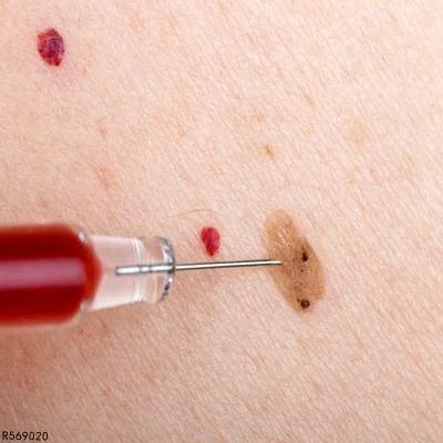 皮下脂肪瘤怎么预防