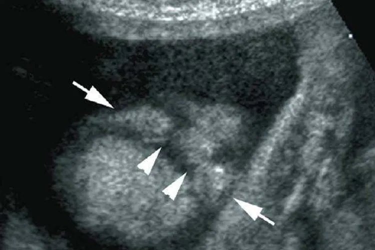 早孕双侧唇裂图片