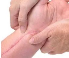 激光去疤痕整形多少钱