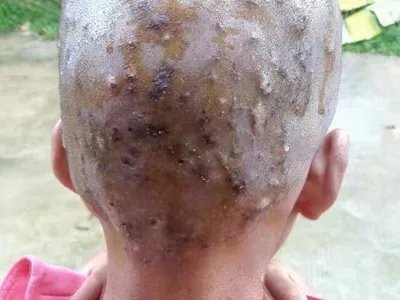 毛囊炎疙瘩图片