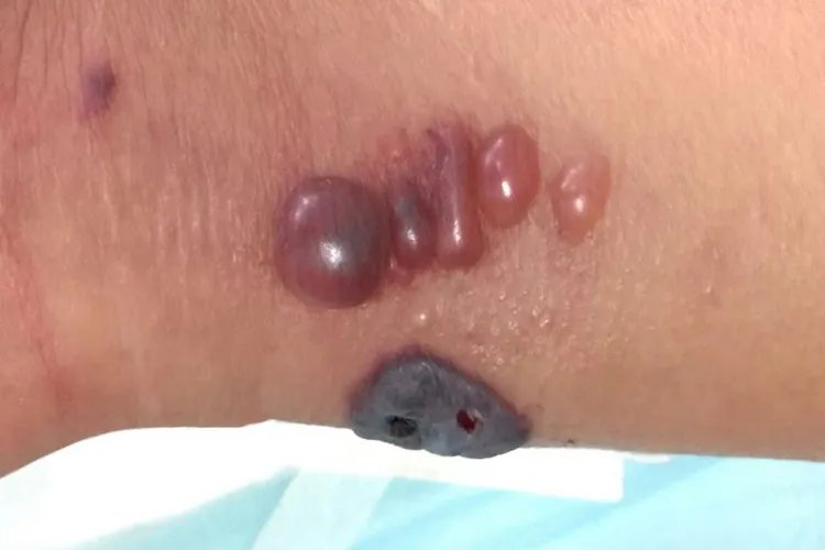 人皮肤炭疽病初期症状图片