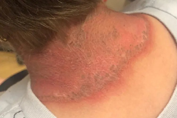 颈部蜂窝组织炎图片