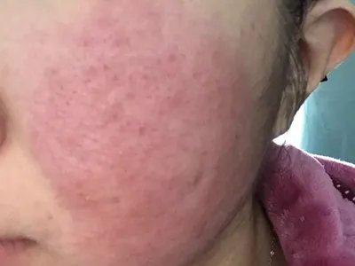 皮肤过敏红肿红点图片