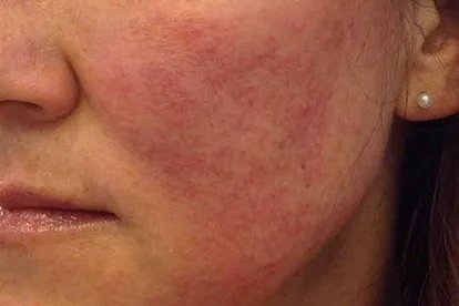 花生过敏长红疹子图片