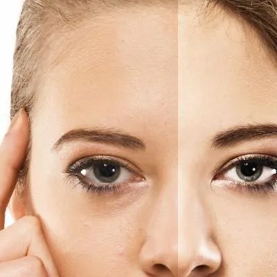 玻尿酸瑞兰2号价格