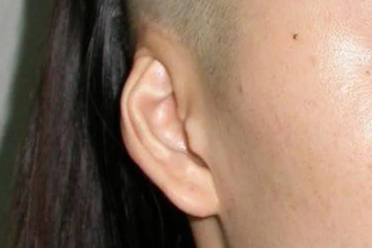 先天性耳朵畸形图片